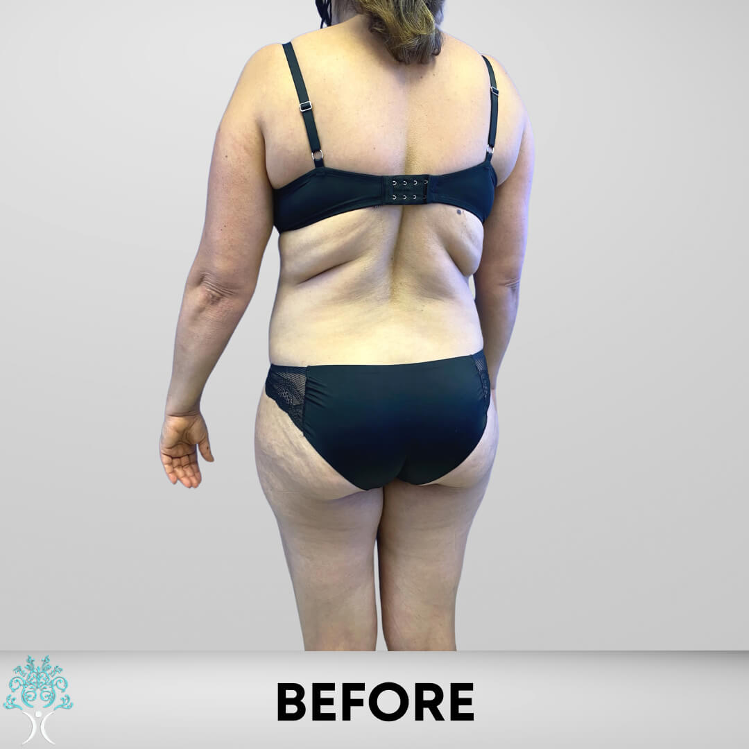 Before tummy tuck