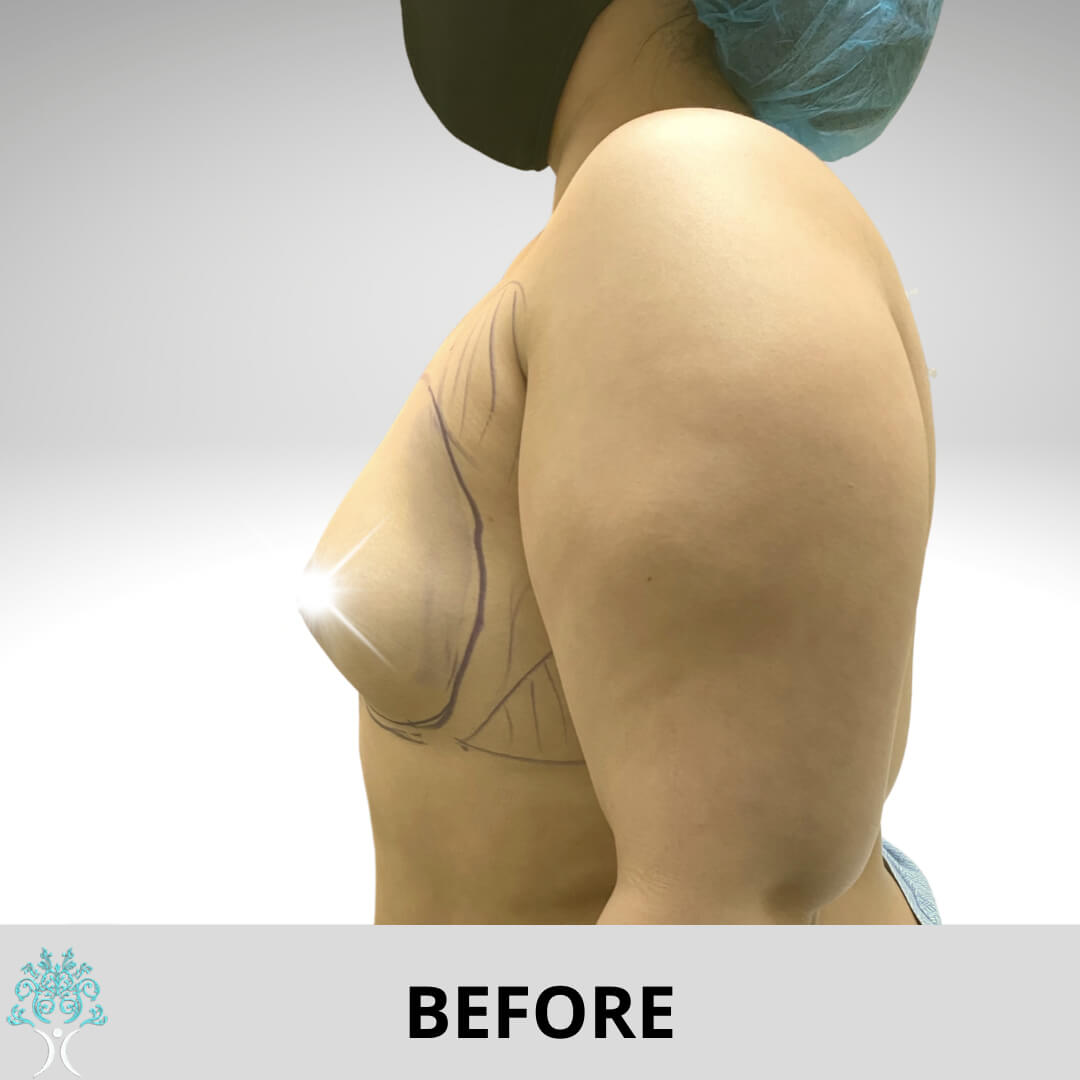Before augmentation surgery