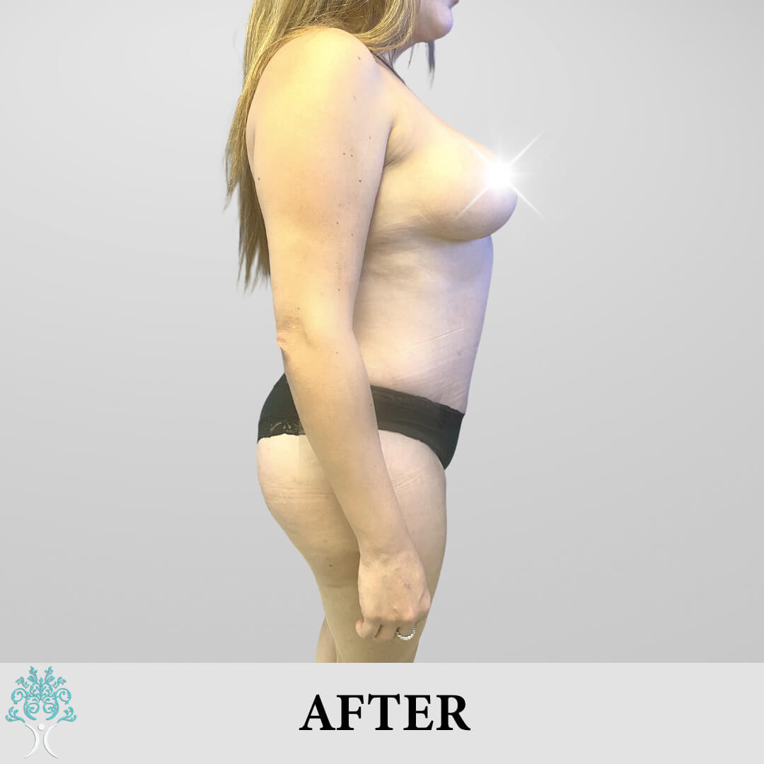 Liposuction & TT After