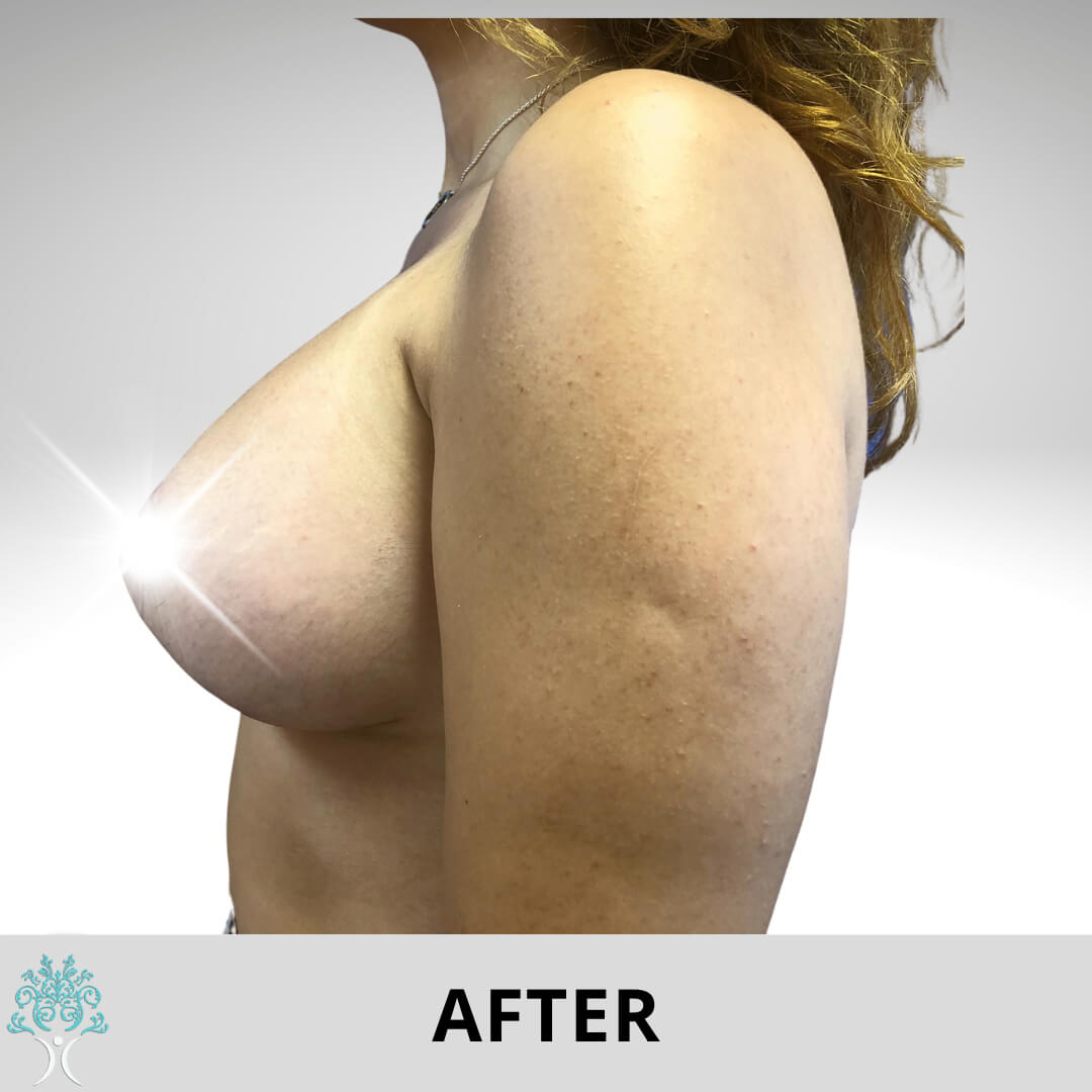 BREAST AUGMENTATION AND LIFT AFTER