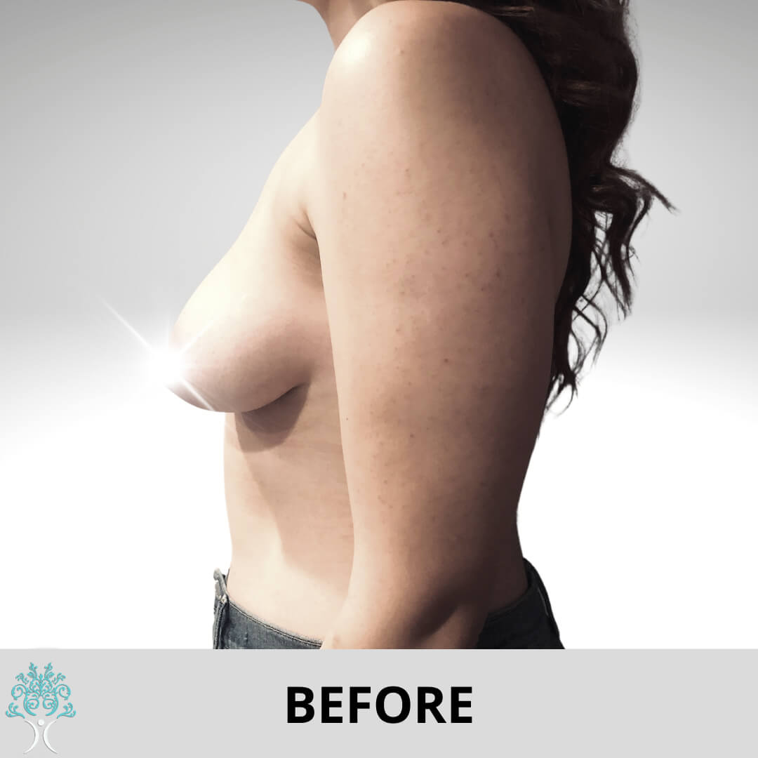 BREAST AUGMENTATION AND LIFT Before