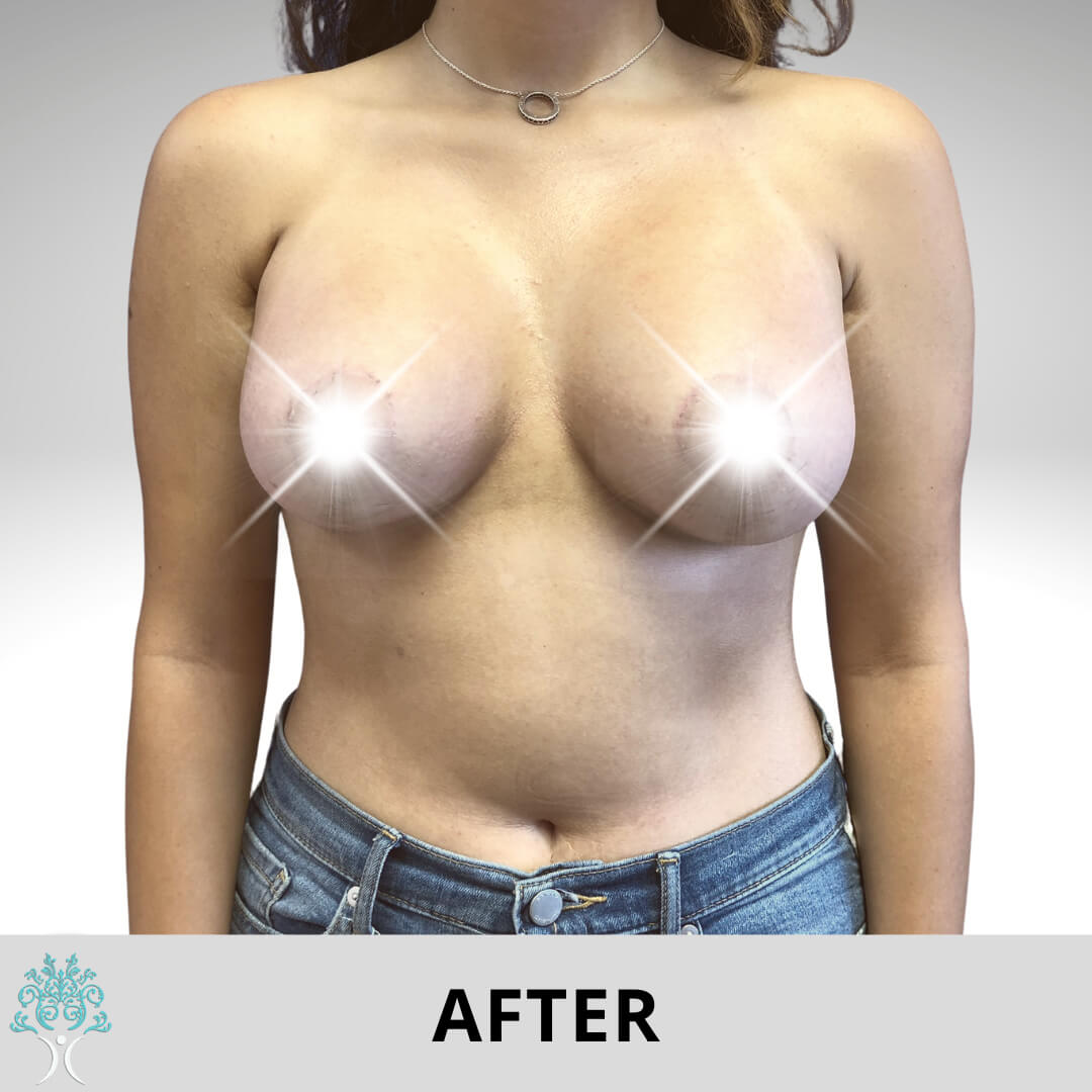 BREAST AUGMENTATION AND LIFT SURGERY AFTER