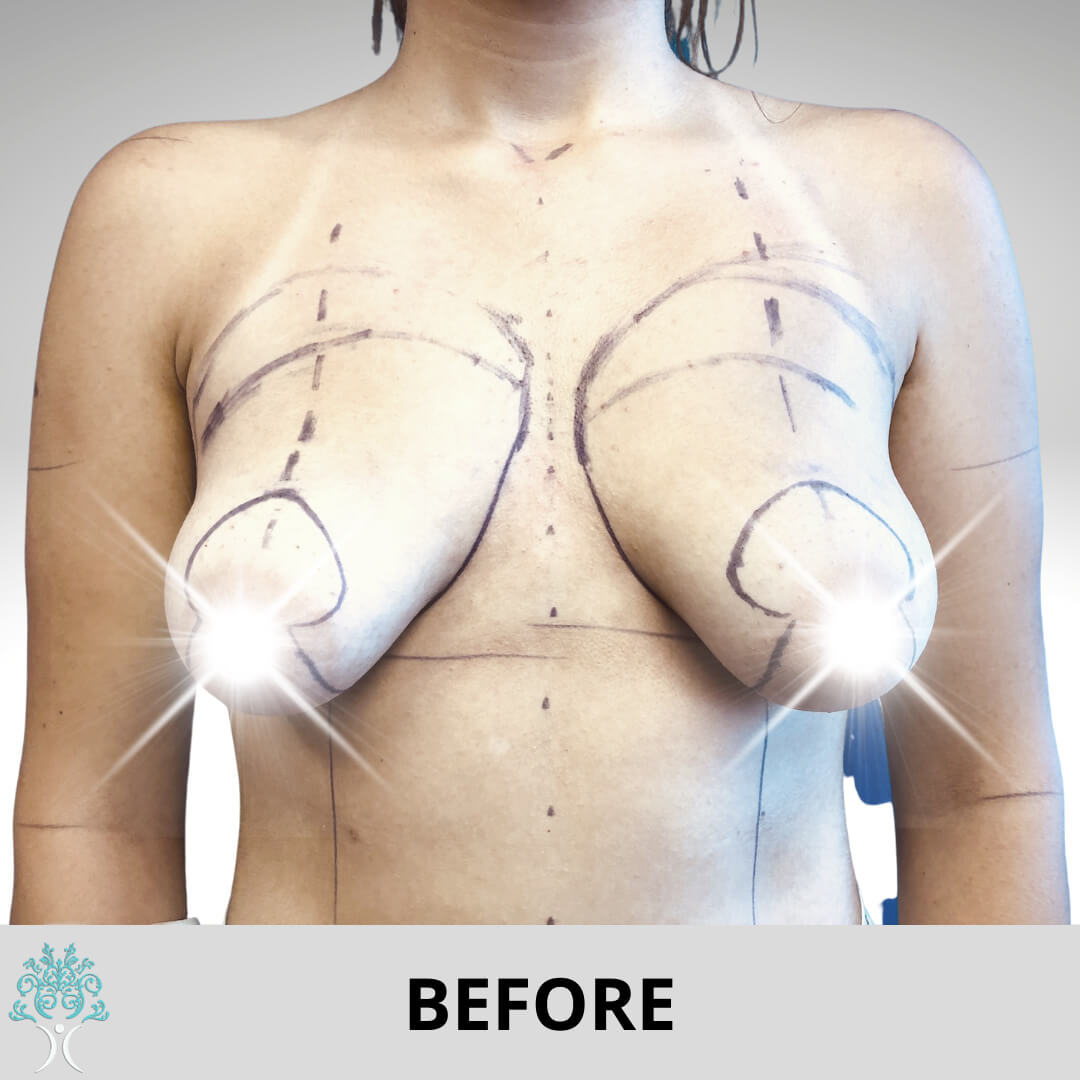 BREAST AUGMENTATION AND LIFT SURGERY BEFORE
