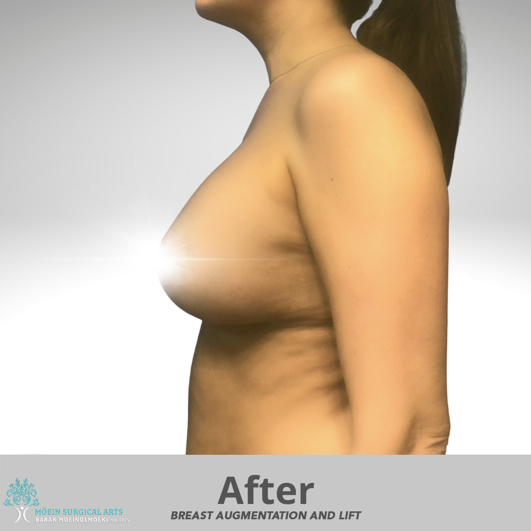 After Breast Augmentation-Los Angeles CA