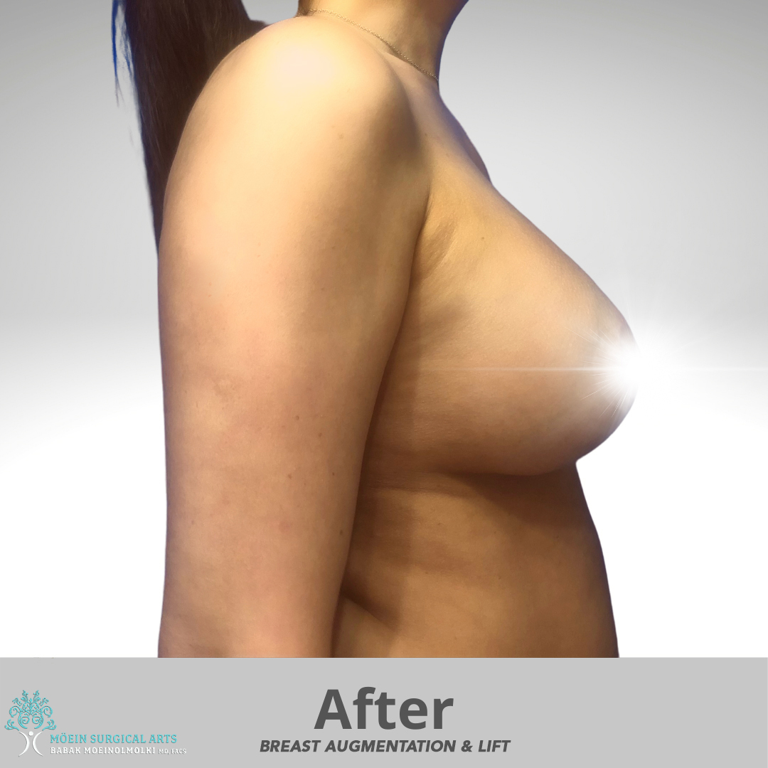After breast aug with lift