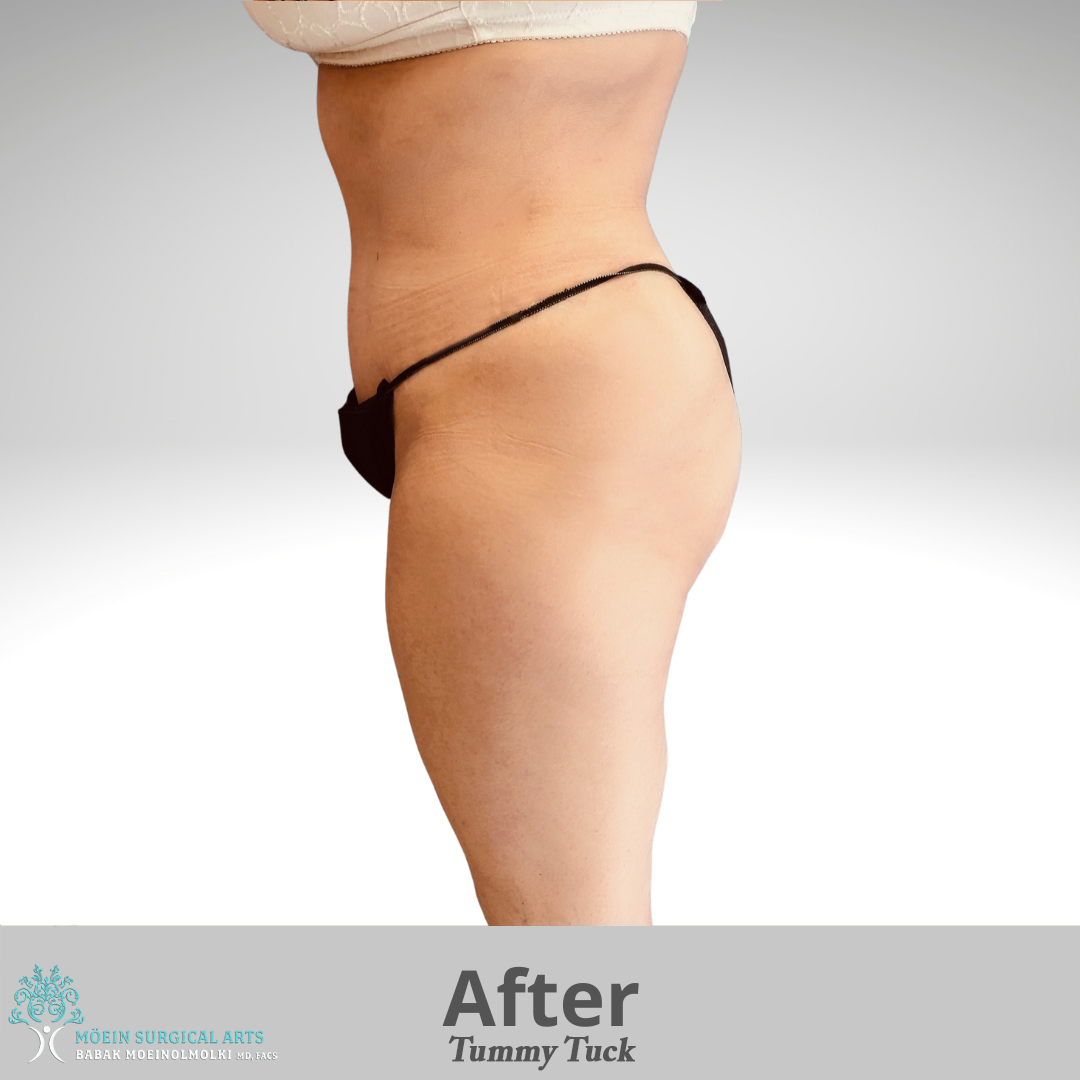 Tummy Tuck Surgery after