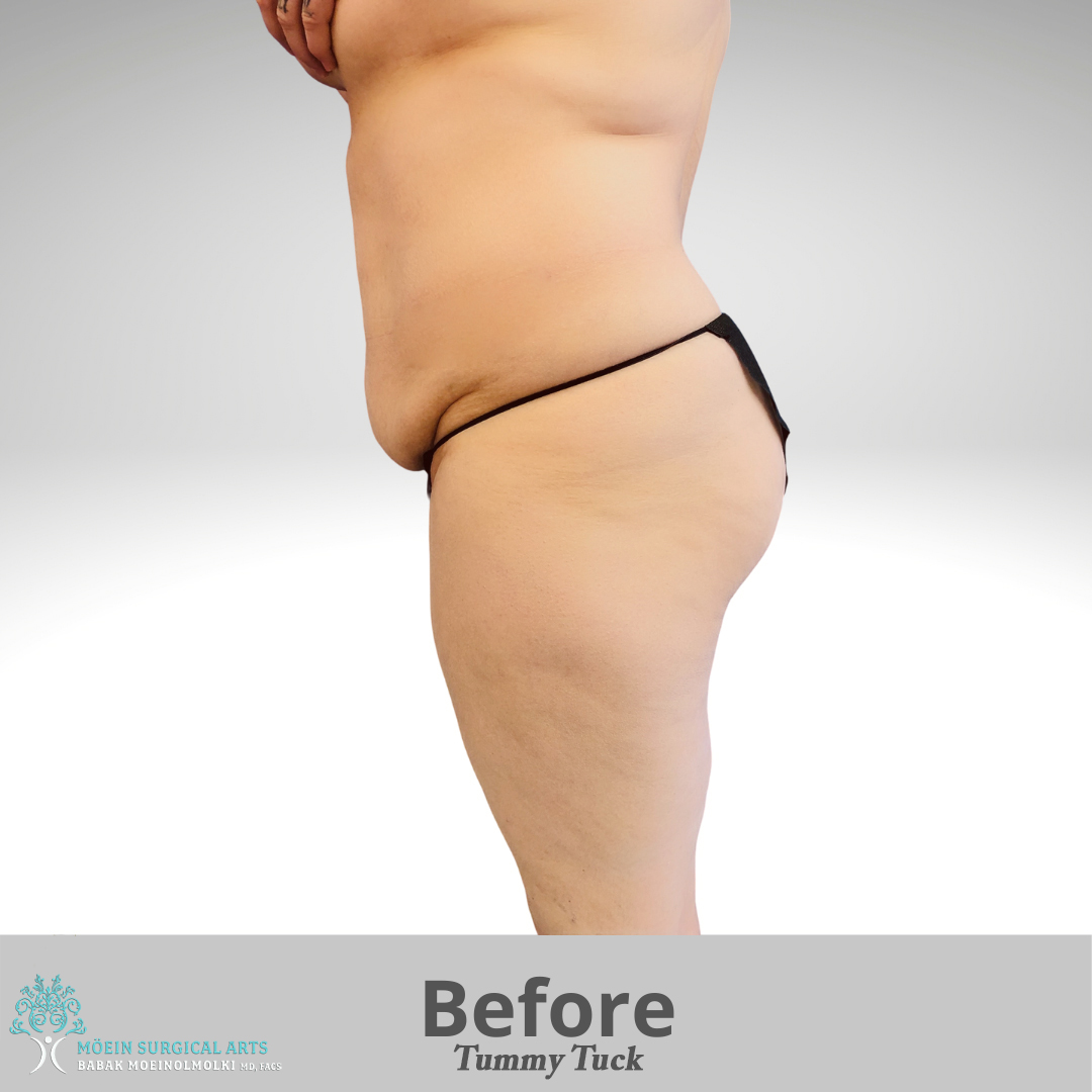 Tummy Tuck Surgery before