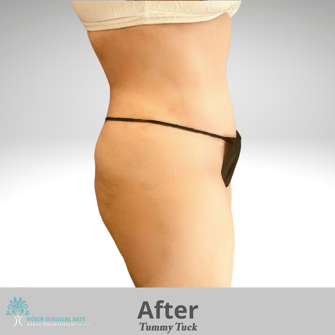 Tummy Tuck after