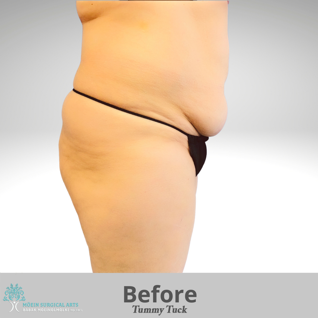 Tummy Tuck before