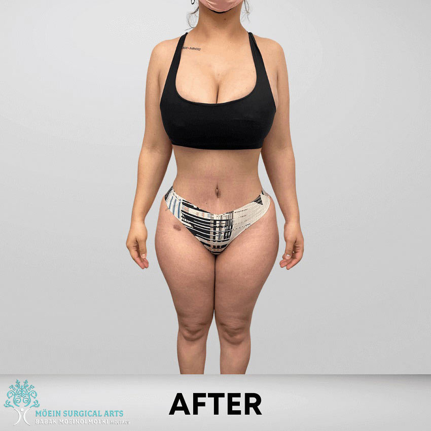 After 360 lipo