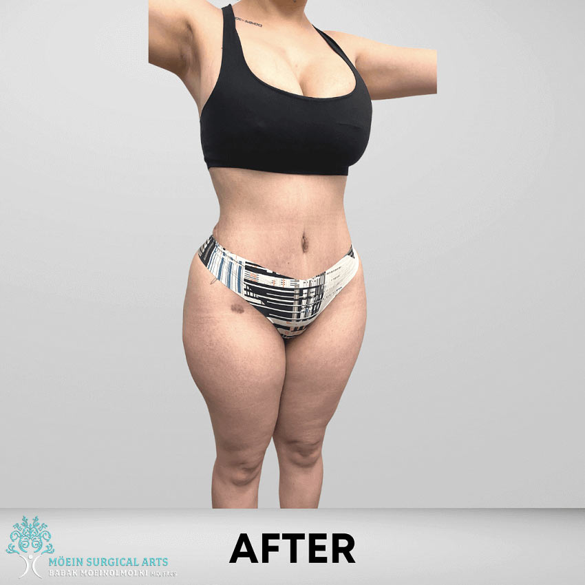 After-Tummy Tuck
