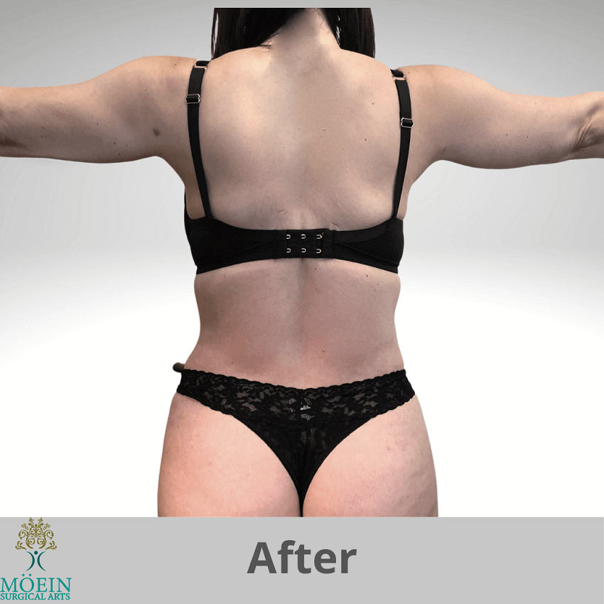 After-Tummy Tuck & Lipo