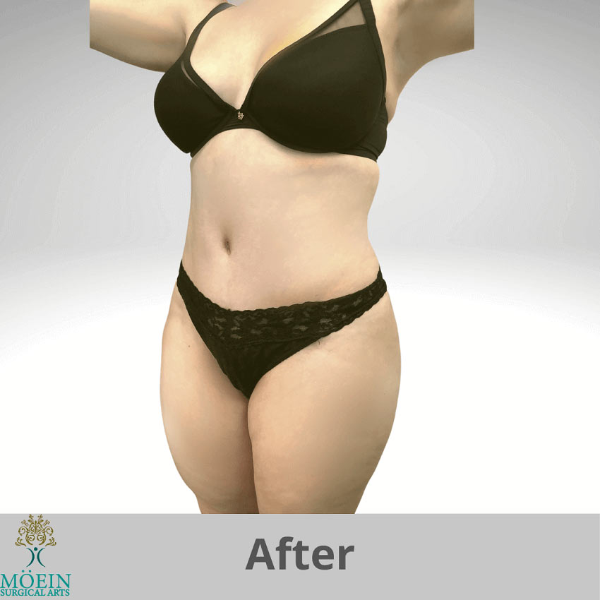 After Tummy Tuck