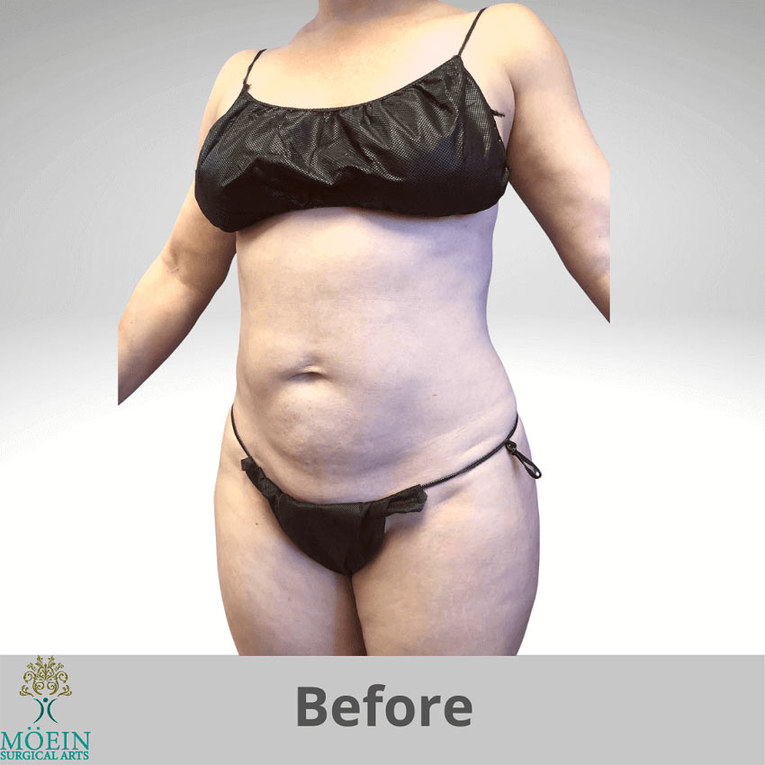 Before Tummy Tuck