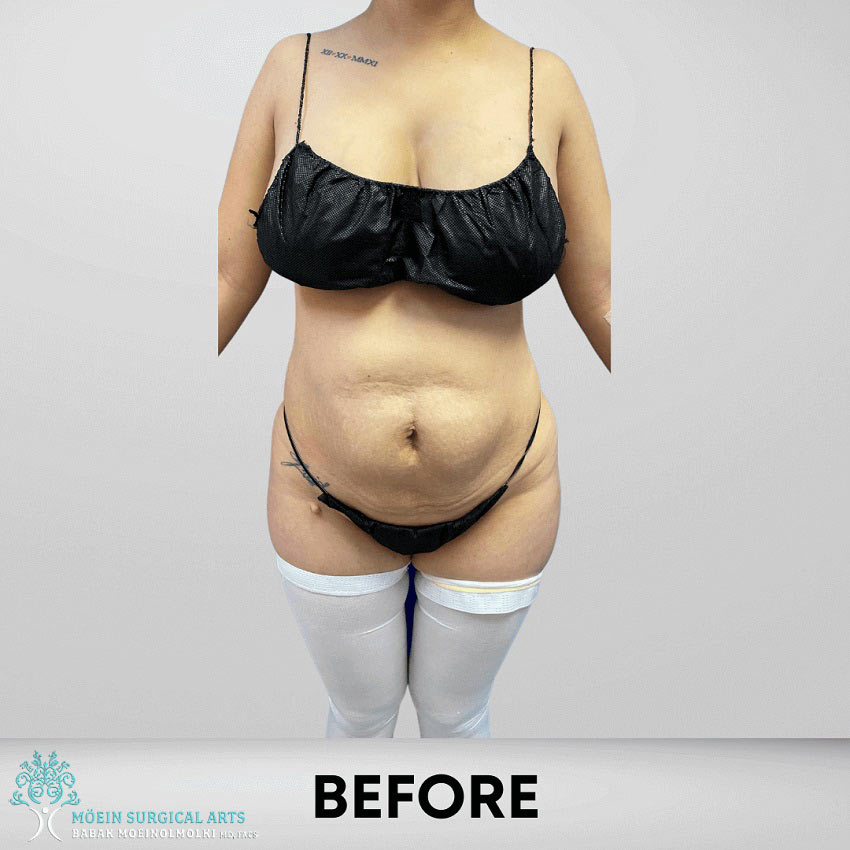 Before 360 Lipo