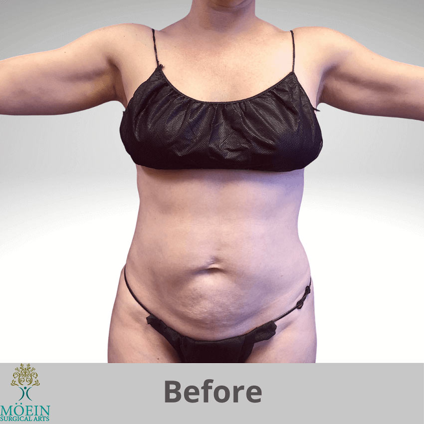Before Tummy Tuck & Liposuction