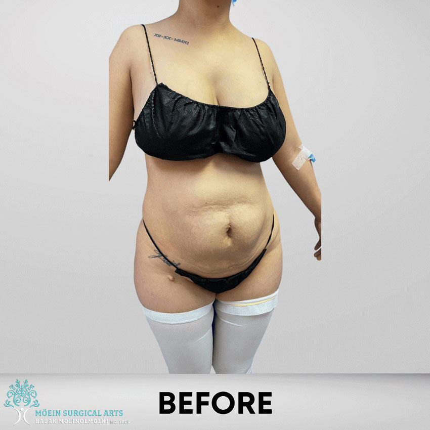Before-Tummy Tuck