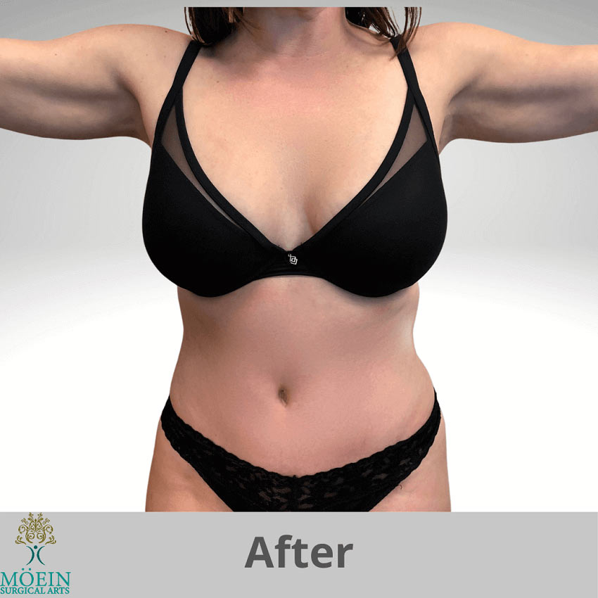 after Tummy Tuck & Lipo