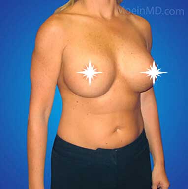 After Breast Augmentation- Los Angeles