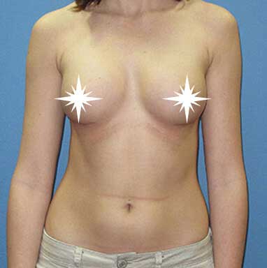 After Breast Augmentation- LA