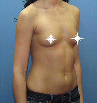 Before Breast Augmentation- Los Angeles