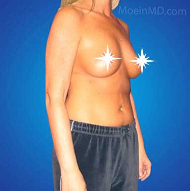Before Breast Augmentation- Los Angeles