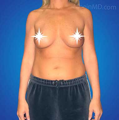 Before Breast Augmentation- Los Angeles