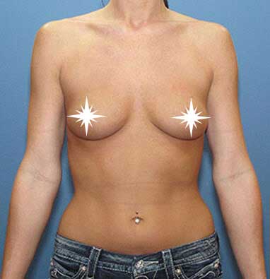 After Breast Augmentation- Los Angeles CA