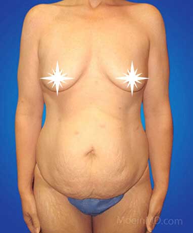 Before Breast Augmentation- LA