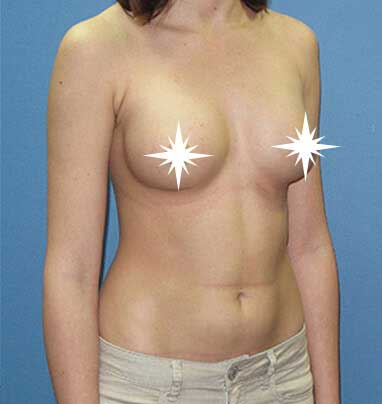 After Breast Augmentation- LA