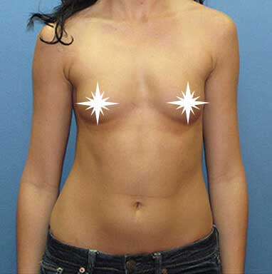 Before Breast Augmentation in Los Angeles