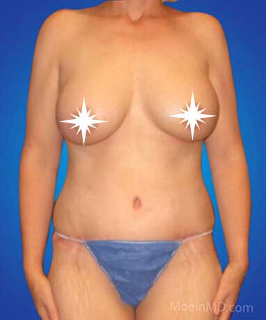 After Breast Augmentation in Los Angeles CA