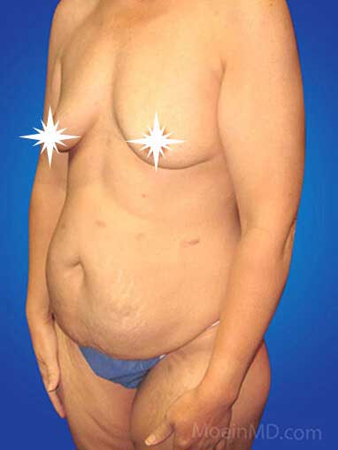 Before Breast Augmentation- LA
