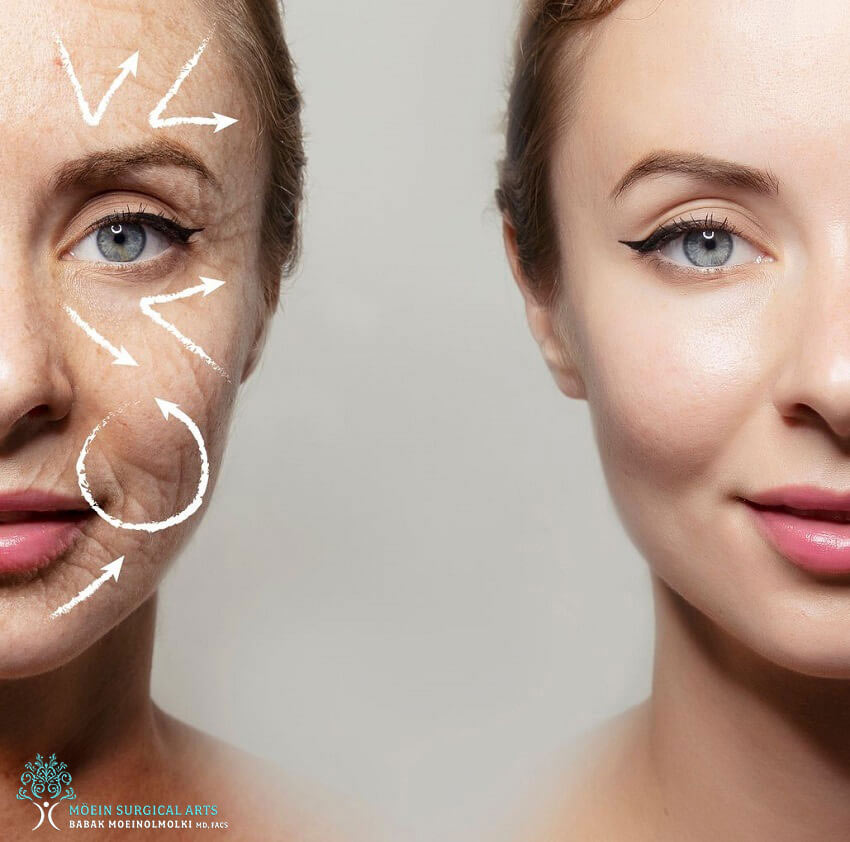 Forma Laser Skin Tightening& Wrinkle Treatment Los Angeles