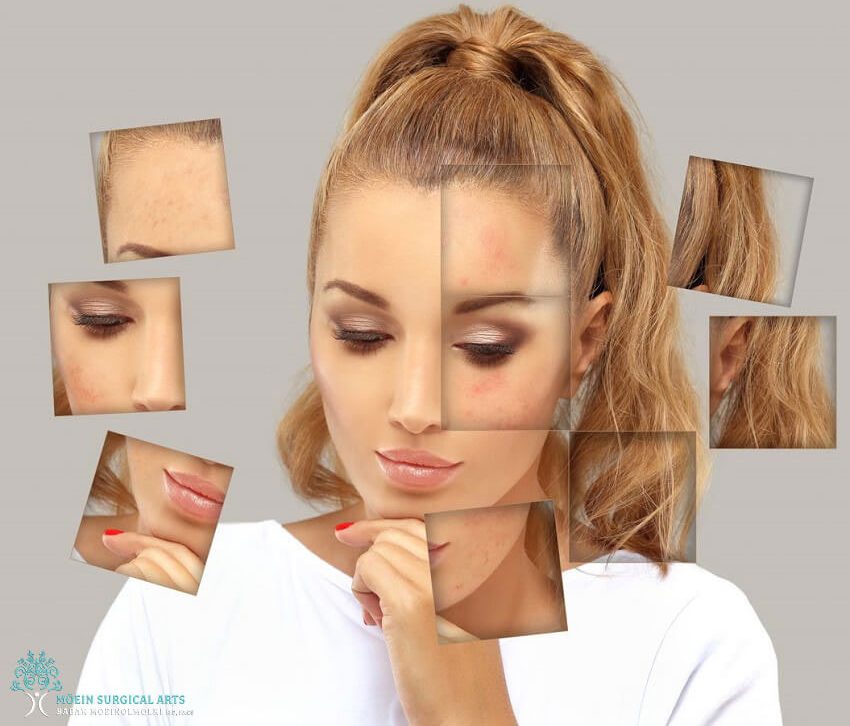 Los Angeles Lumecca IPL Skin Rejuvenation